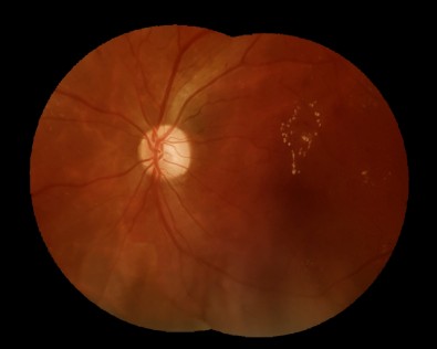 Retinopatia diabética; imagem: divulgação