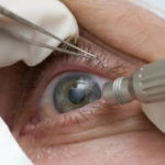 Cirurgia que altera cor do olho tem uso restrito para pessoas cegas